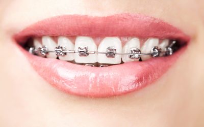 Urgence orthodonthique