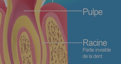 Traitement endodontique, dévitalisation et infection dentaire
