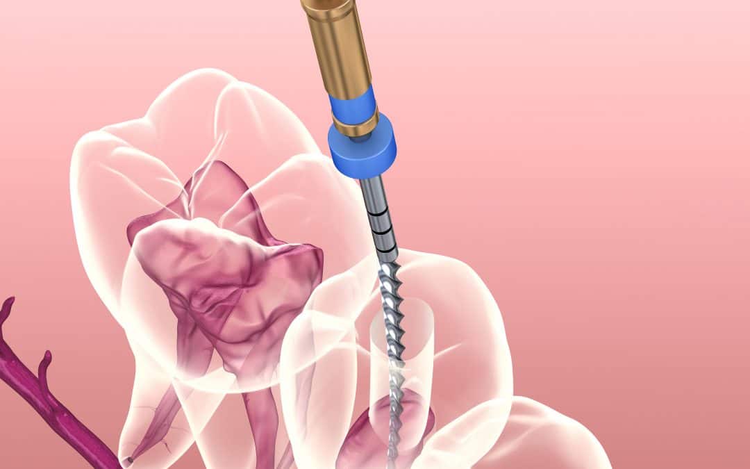 Endodontie : son rôle et ses risques