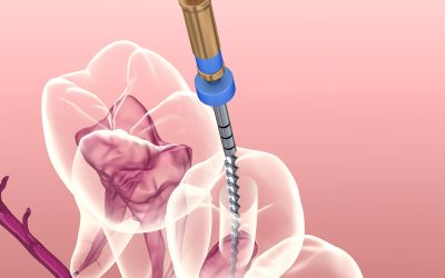Endodontie : son rôle et ses risques