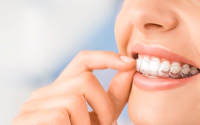 Alignement des dents : Comment retrouver son sourire ?