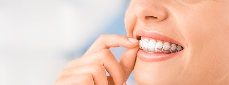 Alignement des dents : Comment retrouver son sourire ?