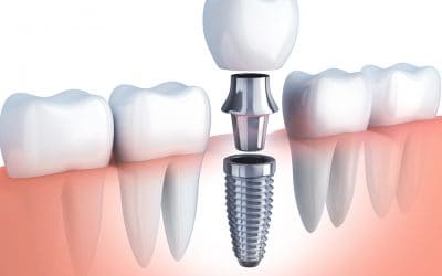 Édentation partielle : Quels sont les traitements ?