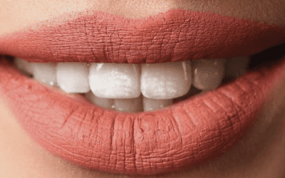 Fluorose : que faire pour enlever les tâches blanches sur les dents ?