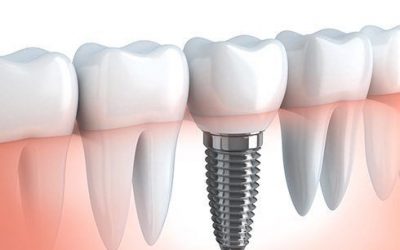 Dentiste implantologue : qu’est-ce que c’est ?