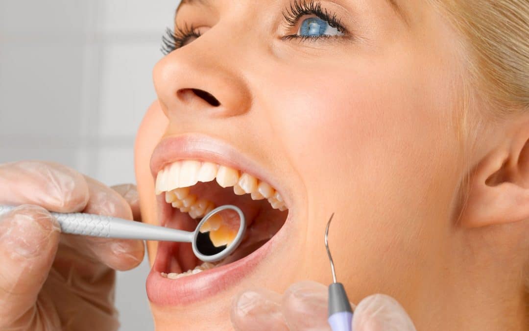 Tartre dentaire : les symptômes, causes et comment l’enlever ?