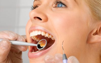 Tartre dentaire : les symptômes, causes et comment l’enlever ?