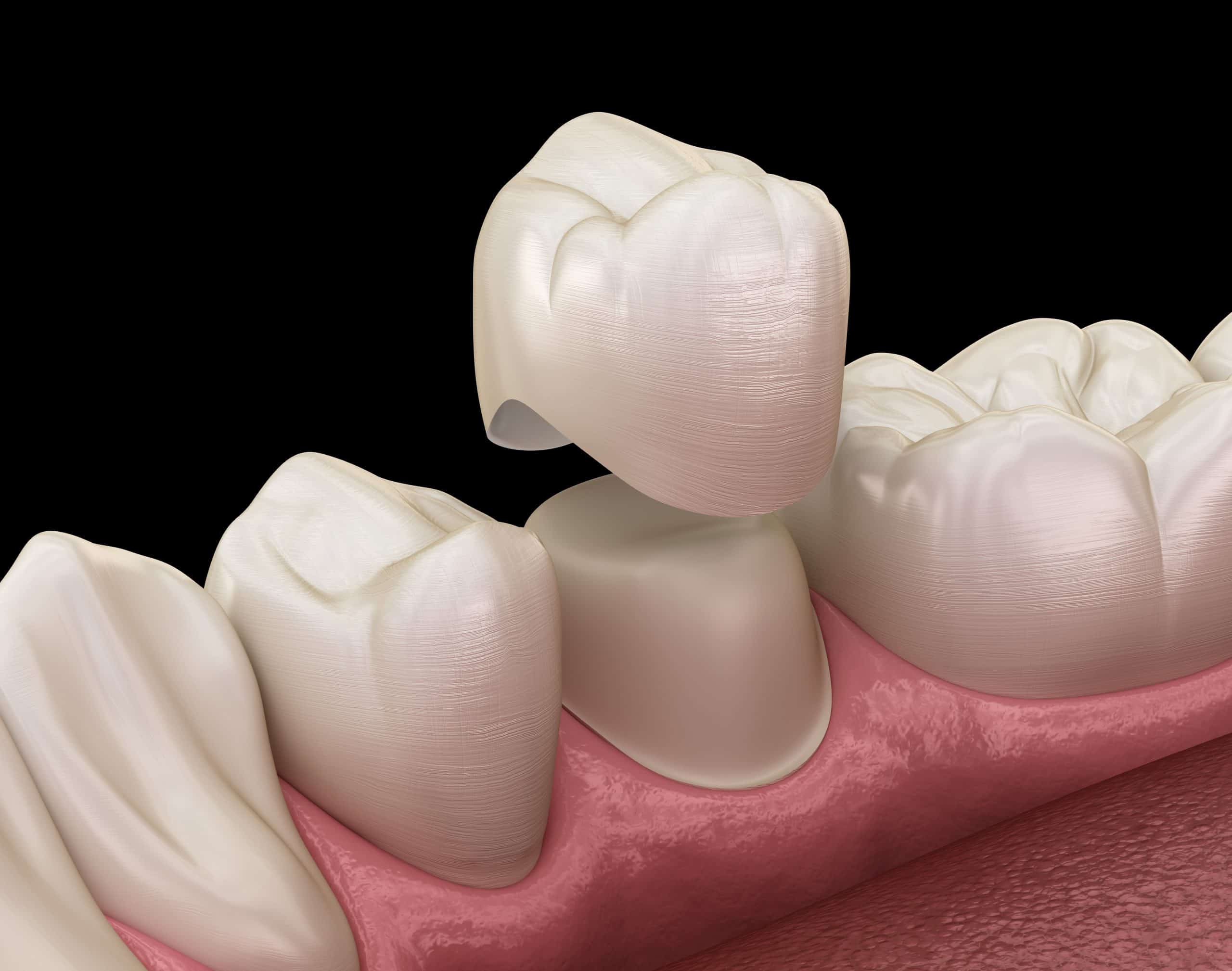 Dental corner - Une couronne provisoire au résine