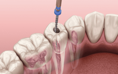 Remboursement de l’endodontie : quelle prise en charge ?