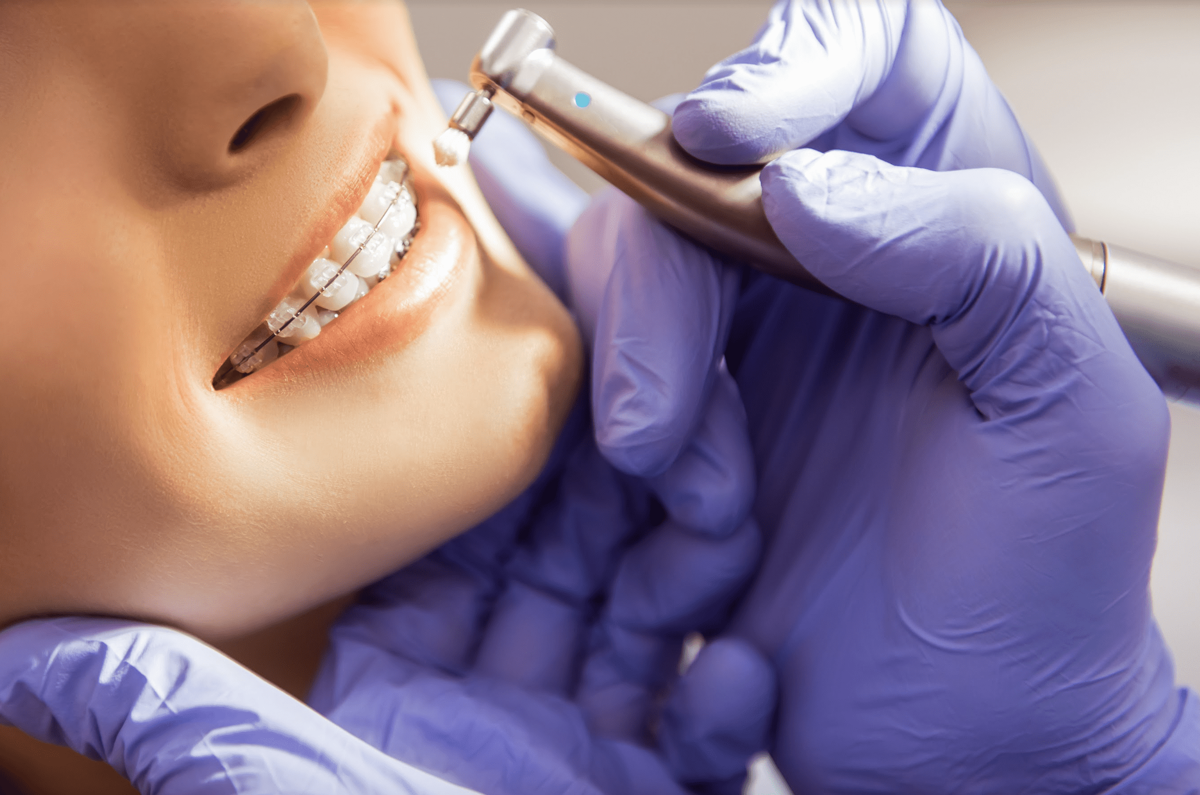 Как стоматологи делают чистку зубов. Стоматолог ортодонт. Профессиональная гигиена брекетов. Профессиональная гигиена зубов с брекетами. Стоматолог Эстетика профессии.