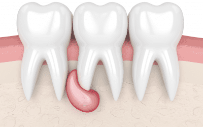 Qu’est-ce qu’un granulome dentaire ?