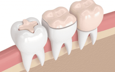 Découvrez toutes les spécificités du pansement dentaire