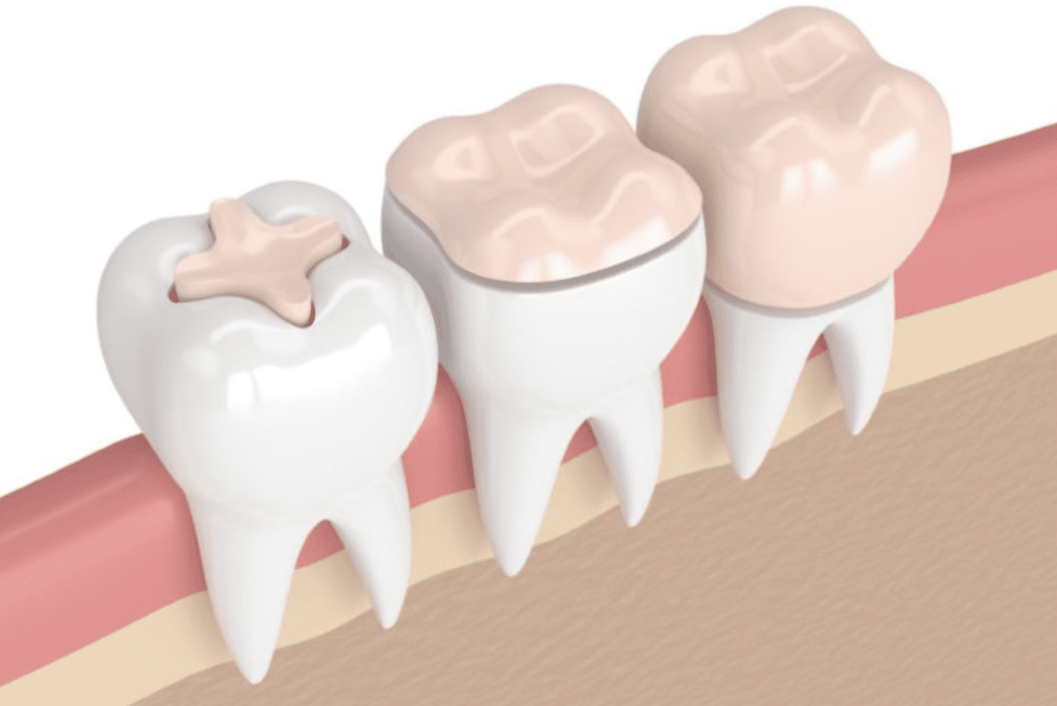 Le pansement dentaire, pour une dentition saine et soignée