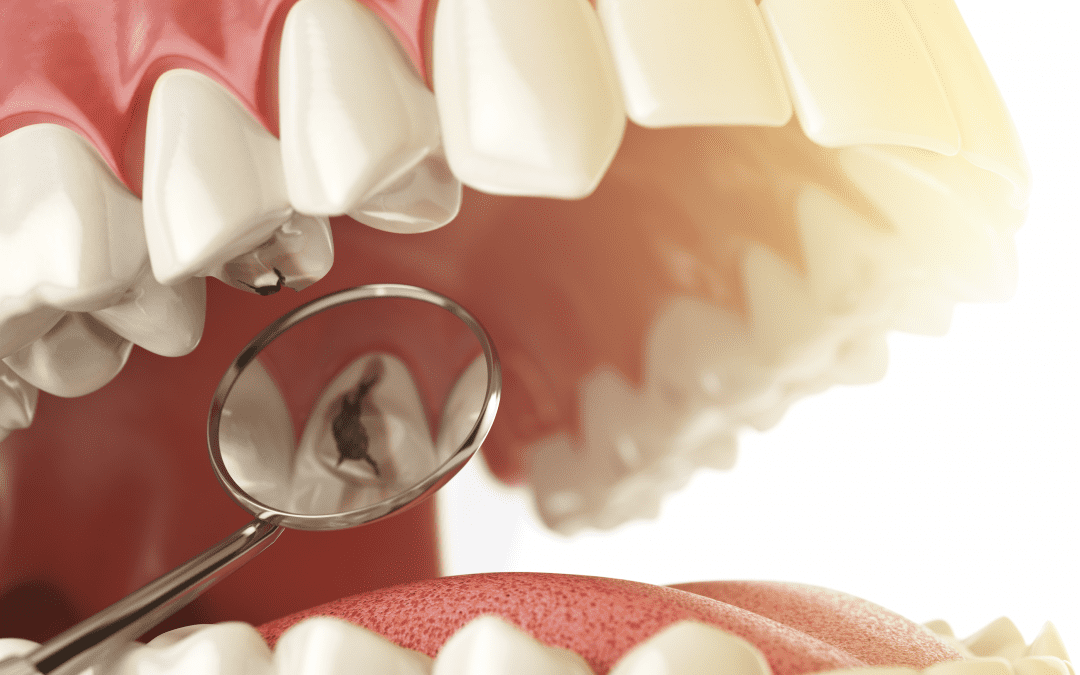 Découvrez toutes les spécificités du pansement dentaire
