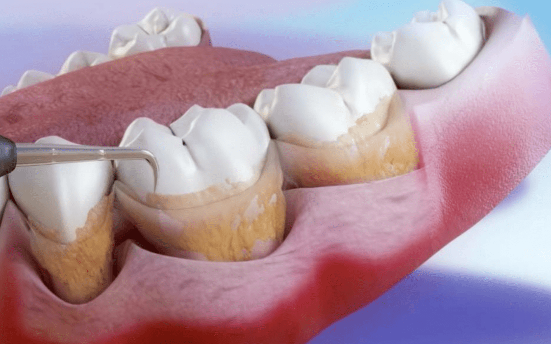 Comment se passe le curetage dentaire ?