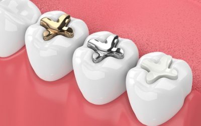 Tout savoir sur le plombage dentaire