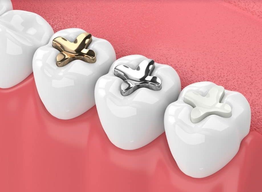 Tout savoir sur le plombage dentaire