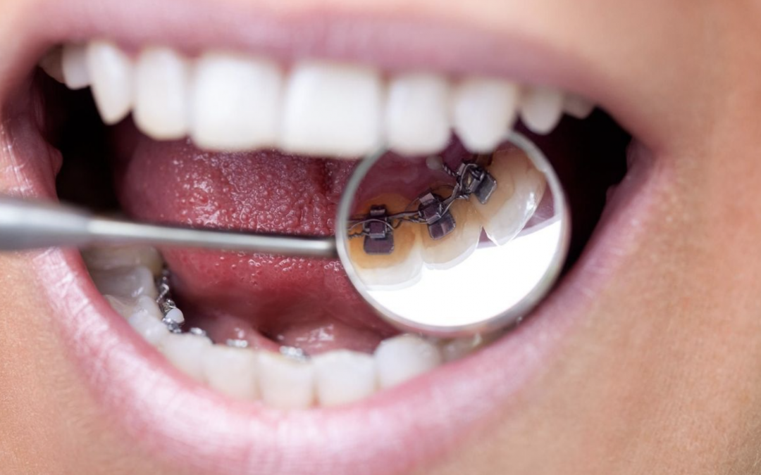 Découvrez notre guide complet de l’orthodontie linguale