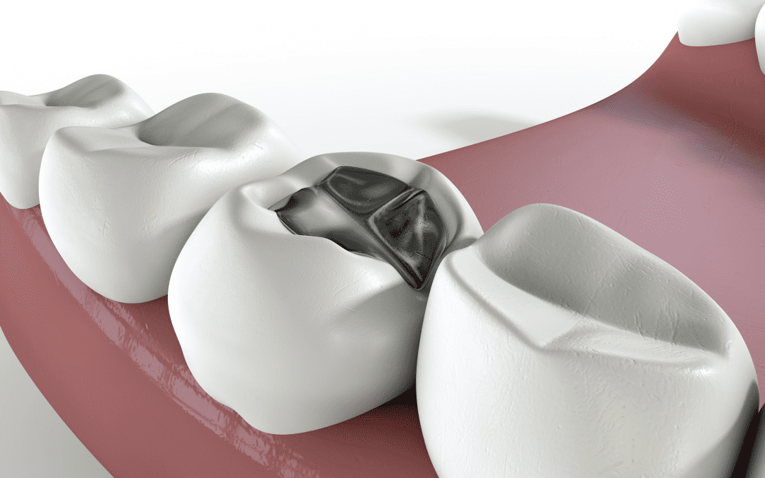 Qu’est-ce qu’un amalgame dentaire ? Quelles précautions d’usage ?