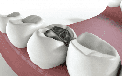 Qu’est-ce qu’un amalgame dentaire ? Quelles précautions d’usage ?