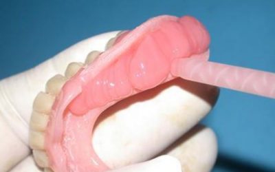Résine souple ou dure : les techniques de rebasage dentaire