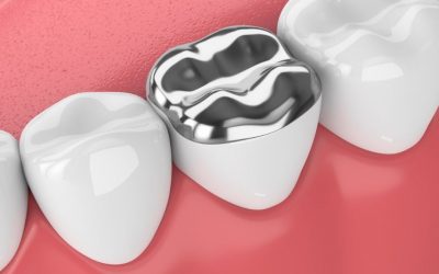 Amalgame ou Composite : comment choisir ?