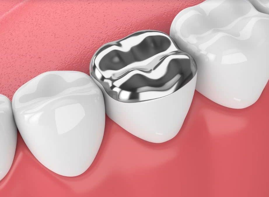 Amalgame ou Composite : comment choisir ?