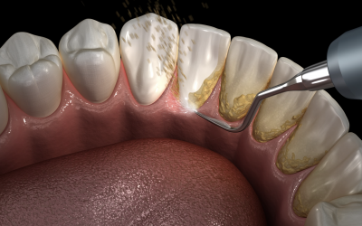 Le détartrage peut-il être nocif pour les dents ?
