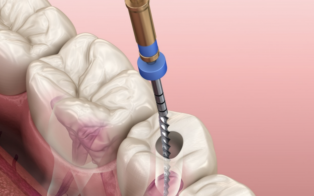 Qu’est-ce que la désobturation endodontique d’une molaire ?