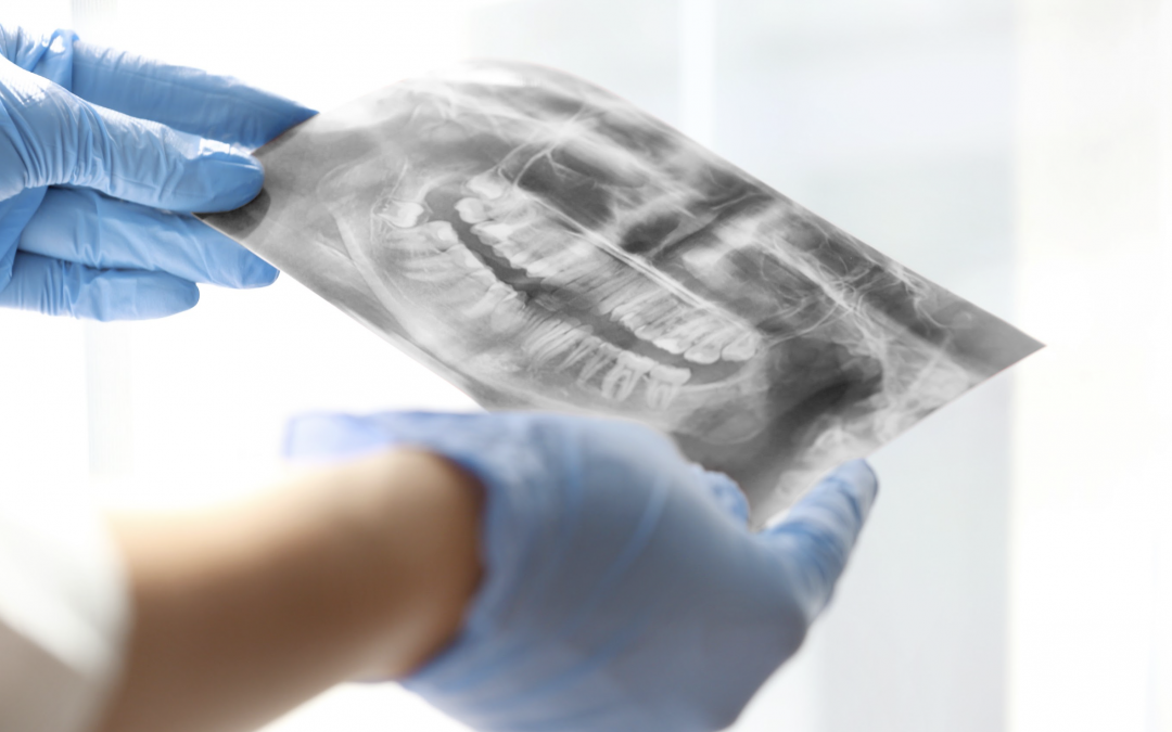 La radiographie dentaire est-elle conseillée pour les enfants ?