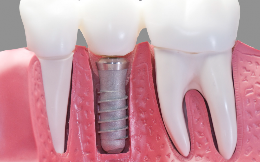 Quelles sont les alternatives à l’implant dentaire ?