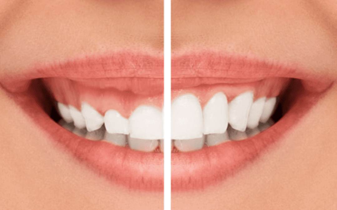 Hyperplasie gingivale : quelles causes, quels traitements ?