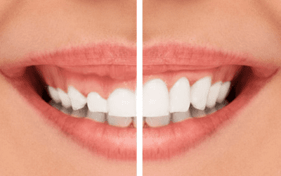 Hyperplasie gingivale : quelles causes, quels traitements ?