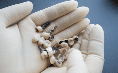 Dent composite : quelle est la durée de vie moyenne ?