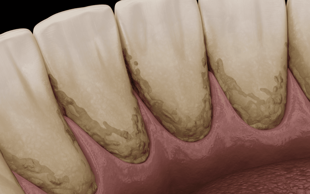 D’où viennent les taches de tartre noir sur les dents ?