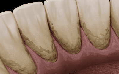 D’où viennent les taches de tartre noir sur les dents ?