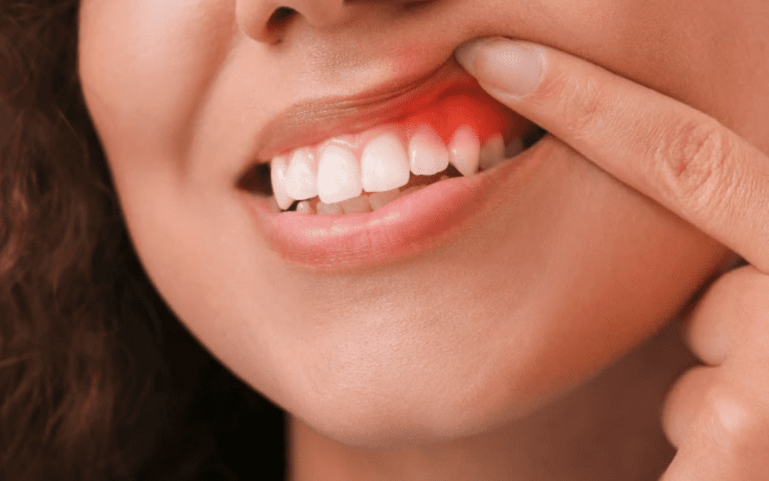 Problèmes parodontaux : quelles sont les maladies ?