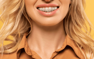 Tout comprendre sur les braquettes (brackets) dentaires