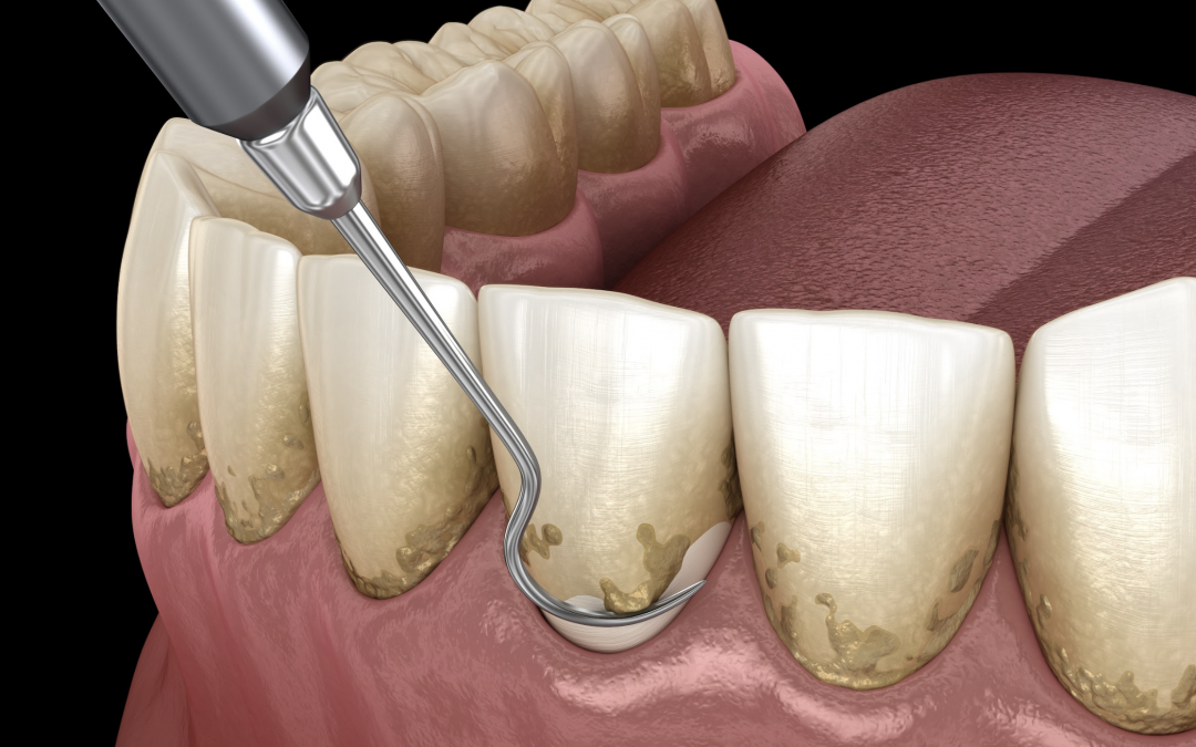 Les bonnes raisons de faire un détartrage des dents