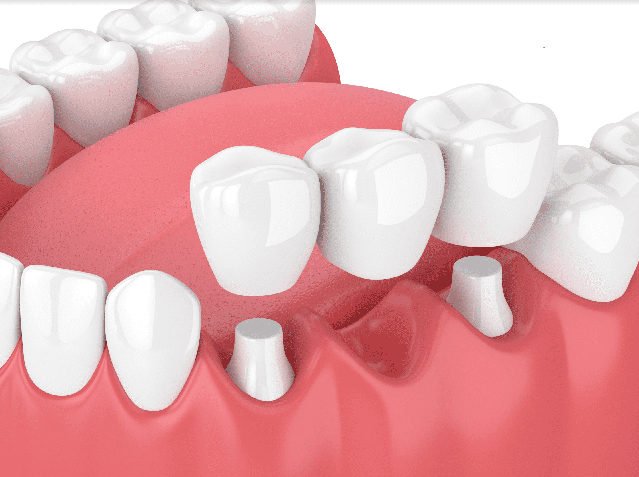 Les conseils d'un spécialiste: Quand mettre couronne dentaire?