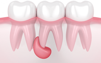 En combien de temps un abcès dentaire disparaît-il ?