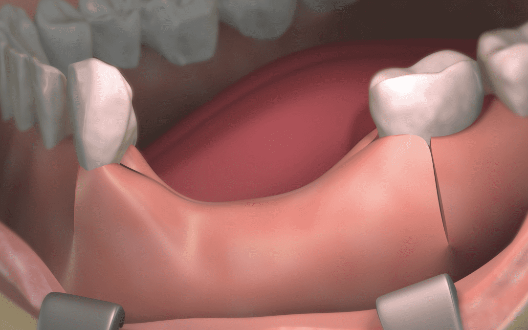 Gencive artificielle : dans quel cas les utiliser ?