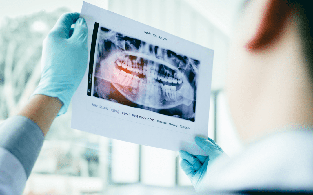 Extraction des dents de sagesse et gonflement : que faire ?