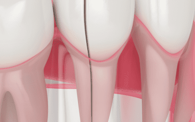 Racine de dent cassée : est-ce dangereux ?