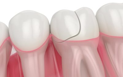 Fracture sur la racine d’une dent dévitalisée : nos conseils