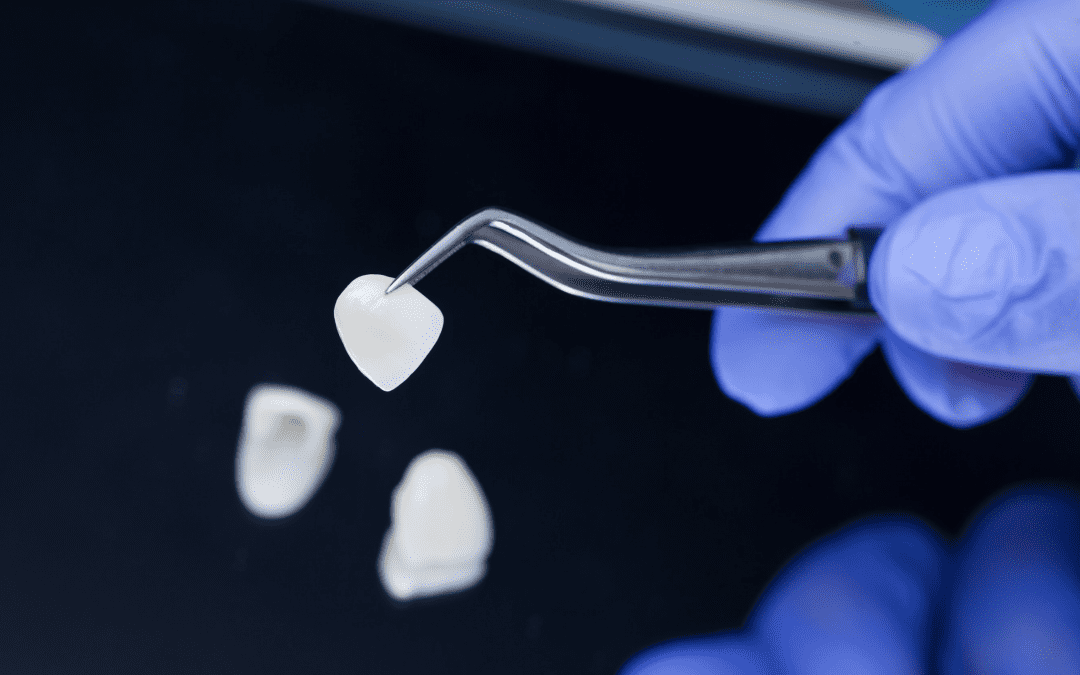 Comment se passe la pose de facettes dentaires ?