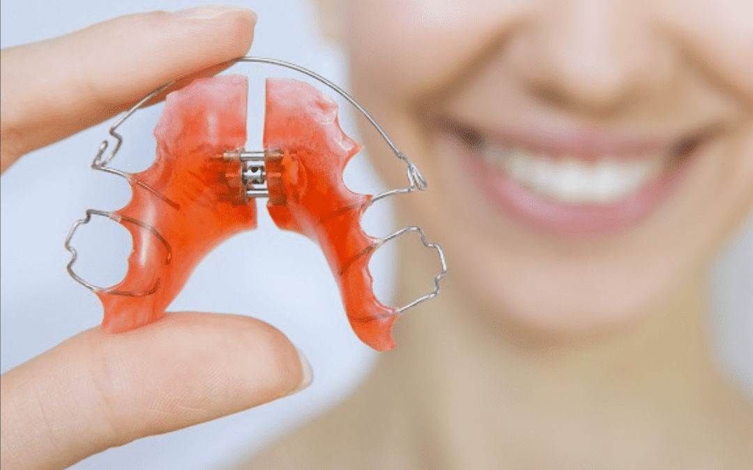 Expansion palatine sans chirurgie adulte