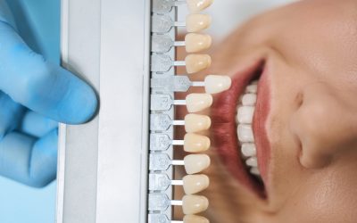 Facette dentaire sur dent dévitalisée : est-ce faisable ?