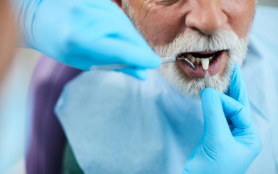 Temps de cicatrisation d’un implant dentaire : quel est-il ?