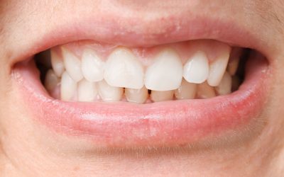 L’impact de la sècheresse buccale sur les dents